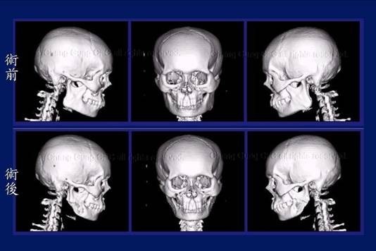 https://www1.cgmh.org.tw/intr/intr2/c32540/photo/img-facial3-002.jpg