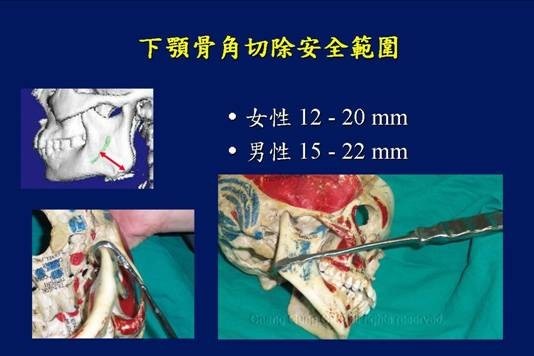 https://www1.cgmh.org.tw/intr/intr2/c32540/photo/img-facial3-003.jpg
